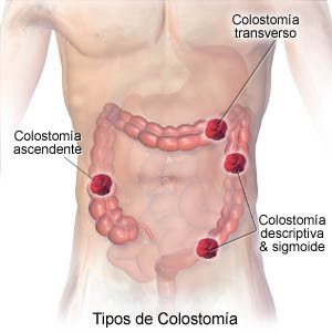 Types of ostomy | Stoma types | Types of stomas