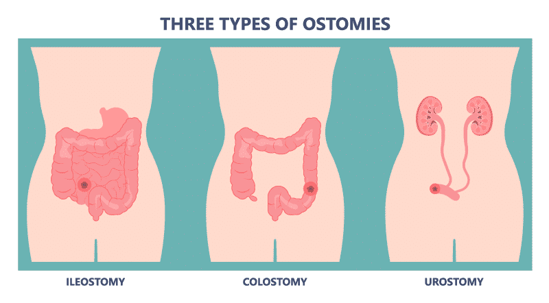 Tipos de ostomia - colostomia ileostomia urostomia SIIL Ostomy