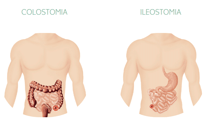 colostomia ileostomia SIIL Ostomy