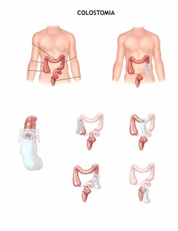 colostomia tipos colostomía SIIL Ostomy