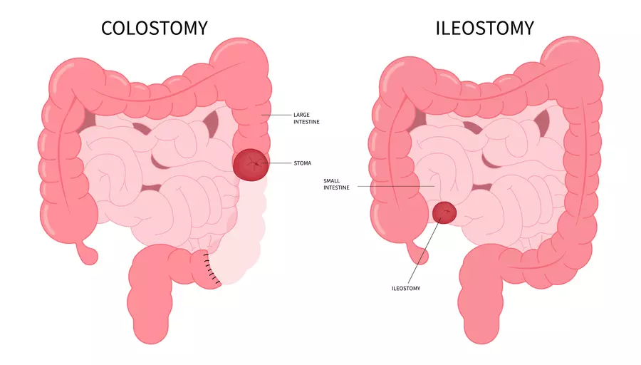 Ileostomy vs Colostomy - Everything you need to know - SIIL Ostomy