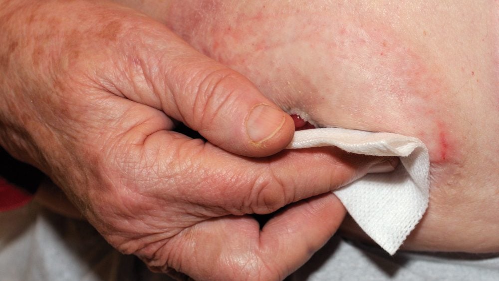 What are the most common skin problems around a stoma?