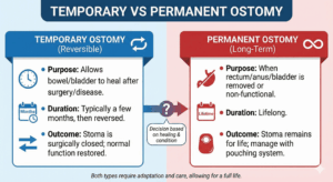 Temporary vs Permanent Ostomy