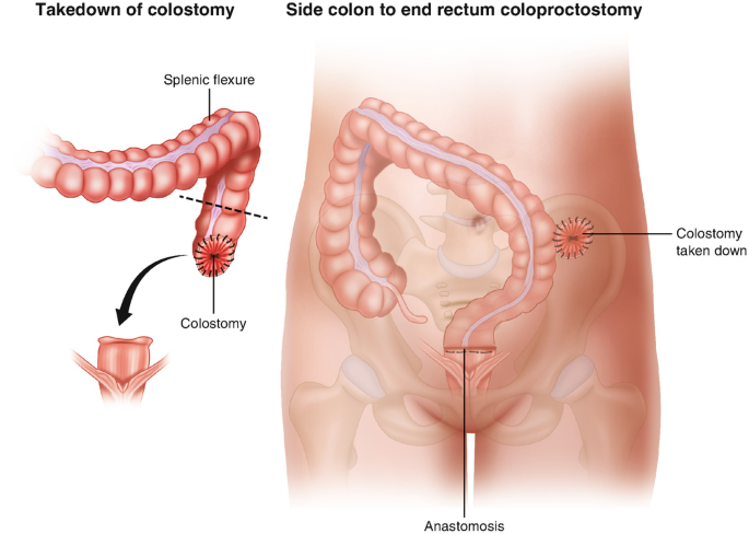 ostomy reversal surgery 2025 - what it is, how it works