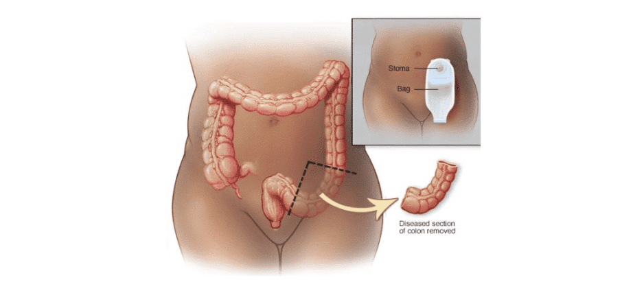 ostomy