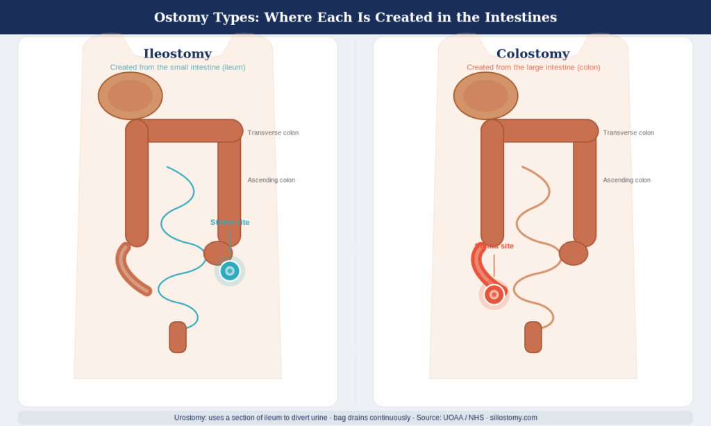 SIIL Ostomy Quick Fix Playbook Ileostomy vs Colostomy: Types of Ostomy Surgery Diagram